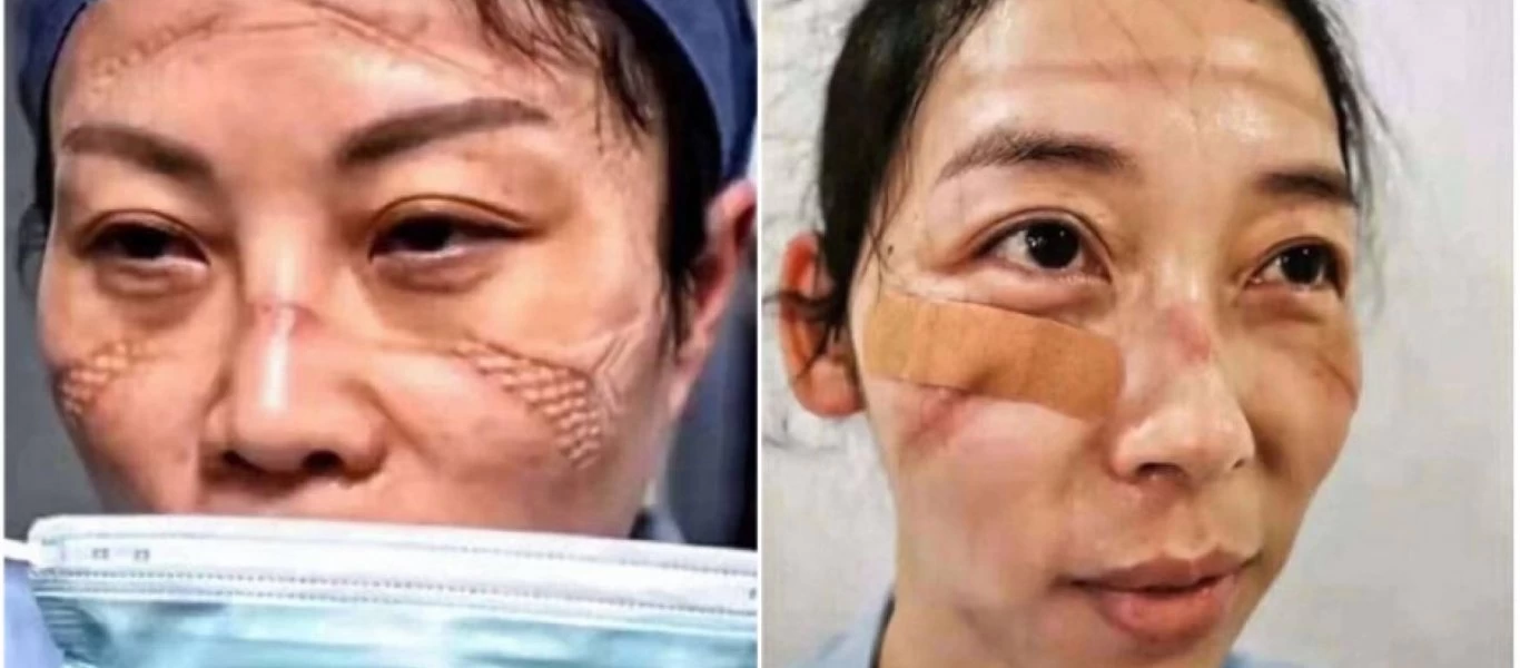 Κίνα: Συγκλονίζουν οι κατάκοποι νοσηλευτές της Ουχάν - Δείτε τις αποκαρδιωτικές φωτογραφίες